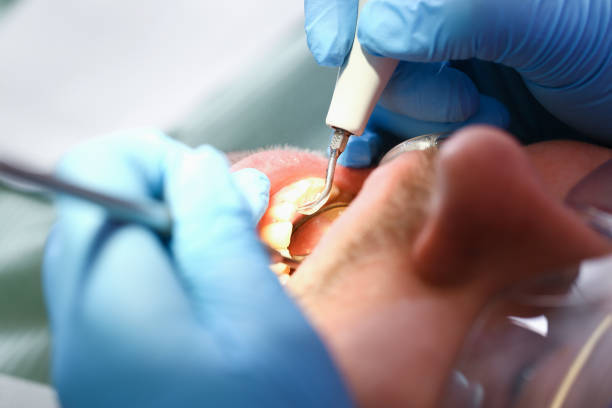 Best Emergency Dentist for Lost Fillings or Crowns in Poth, TX